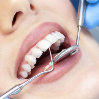 Periodontojoli